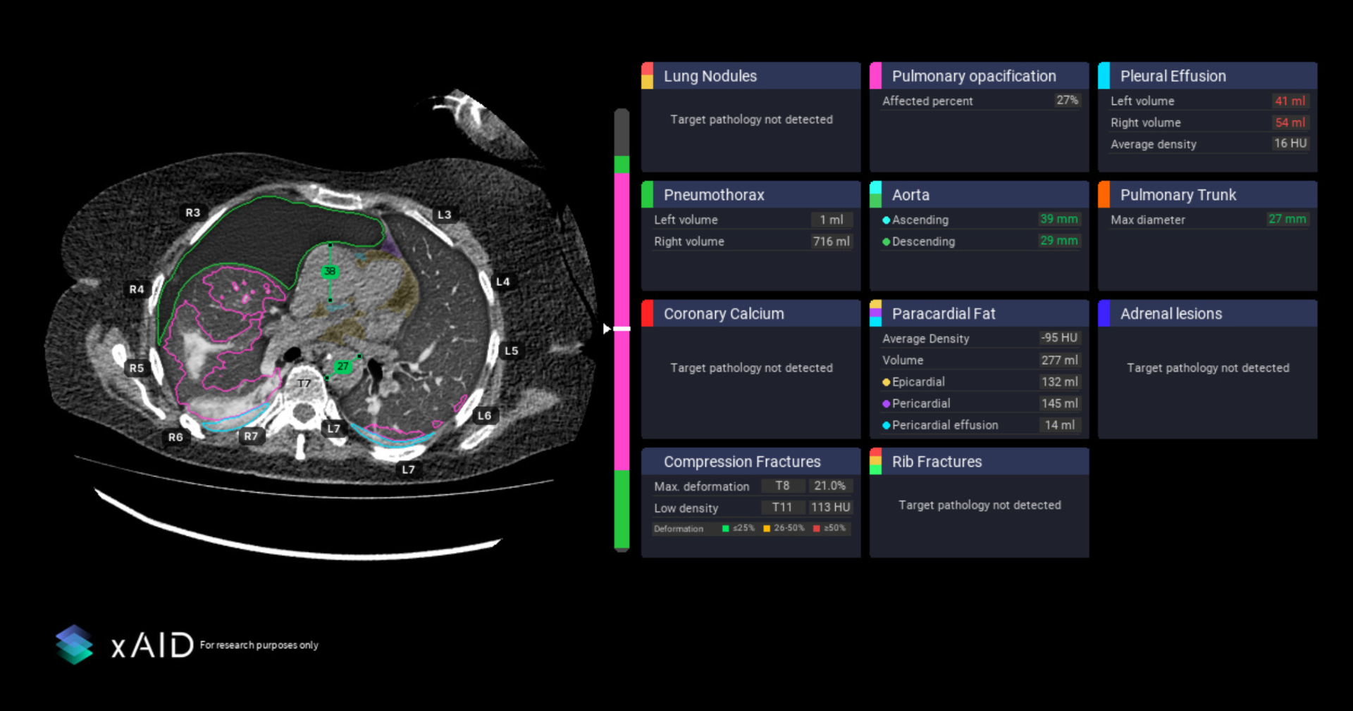 CT scan with AI annotations showing lung nodules, pleural effusion, aorta measurements and other findings